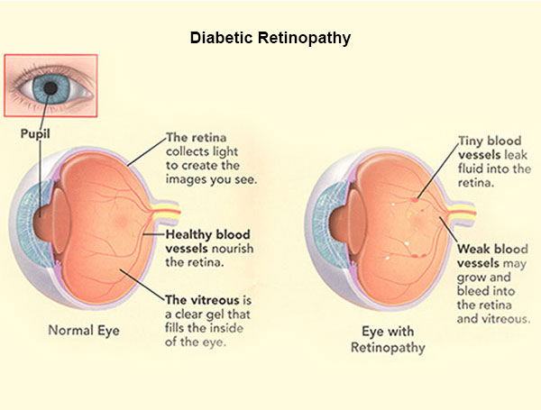 Diabetic-retinopathy