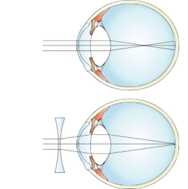 myopia lenses