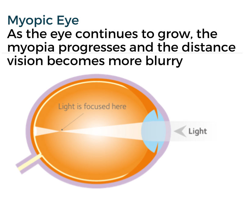 myopic eye